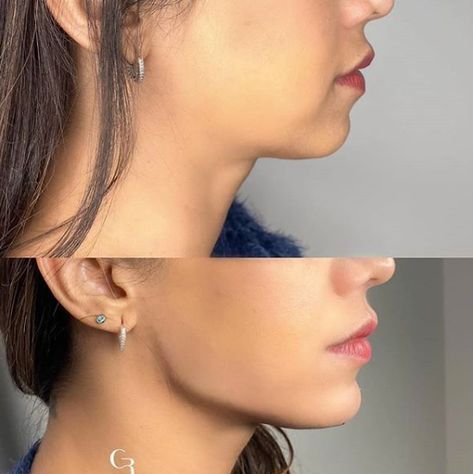 Jawline Filler, Jaw Reduction Surgery, Face Plastic Surgery, Chin Filler, Chin Implant, Face Fillers, Face Surgery, Jaw Surgery, Cheek Fillers