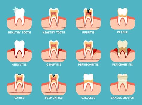 Toothache Remedies, Dental Nursing, Dental Assistant Study, Tooth Cavity, Minimalist Poster Design, Remedies For Tooth Ache, Natural Teeth, Dental Problems, Dental Assistant