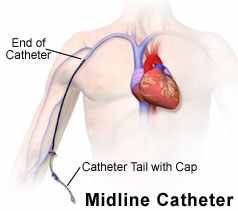 Parenteral Nutrition, Central Venous Catheter, Medical Intern, Picc Line, What Is Nursing, Nursing Cheat, Nursing Assessment, Interventional Radiology, Subcutaneous Tissue