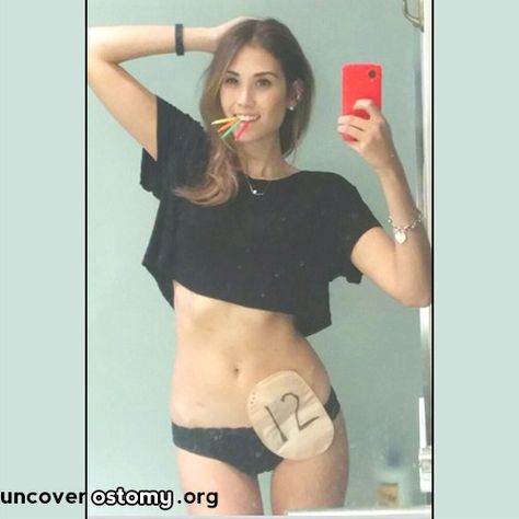 Uncover-Ostomy-12-Year Ostomy Fashion, Ostomy Life, Ostomy Bag, Ehlers Danlos Syndrome, Nursing Notes, Lifestyle Changes, Inspirational People, Thing 1 Thing 2, Love Your