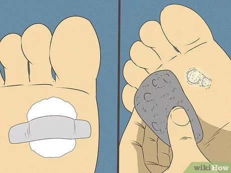 3 Ways to Get Rid of Calluses - wikiHow Diy Callus Remover, Get Rid Of Corns On Feet Fast, Remove Callous From Foot, How To Remove Calluses From Foot, Calloused Feet Remedy, How To Get Rid Of Calluses On Feet Fast, Calluses On Feet Remedies, Foot Soak For Calluses, Callus Remover Diy