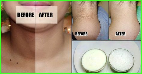 A glowing face and a dark, tanned neck – definitely not a good combo! Time to pamper your dark neck with these simple yet effective home remedies. Have a look Dark Skin Around Neck, Dark Neck Remedies, Dark Neck, Skin Darkening, Tan Removal, Anti Aging Secrets, Glowing Face, Gram Flour, Beauty Tips For Glowing Skin