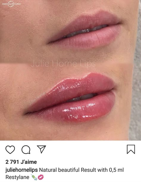 Lip Injections Heart Shape, Ariana Grande Lip Fillers, Lip Filler One Syringe, Lip Filler Inspo Heart Shape, Lip Filler On Small Mouth, Bigger Bottom Lip Filler, Small Lips Lip Filler, Lip Injections Before And After 0.5ml, Lip Filler Before And After Small Lips