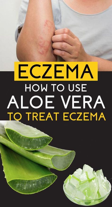 To use aloe vera for eczema, first help your skin absorb as much as possible by cleaning the area first with mild soap and water. Liberally apply aloe vera gel to the affected area. Keep in mind that the gel can be sticky at first. Home Remedies For Warts, Benefits Of Aloe Vera, Warts Remedy, Natural Health Remedies, Natural Home Remedies, Health Remedies, Herbal Remedies, Health And Nutrition, Natural Health