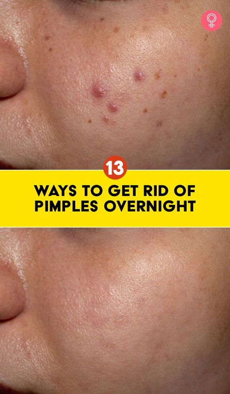 Zit Remedy, Rid Of Pimples Overnight, Redness Pimple, Small Pimples, Blind Pimple, Pimple Marks, How To Reduce Pimples, Get Rid Of Pimples, Rid Of Pimples