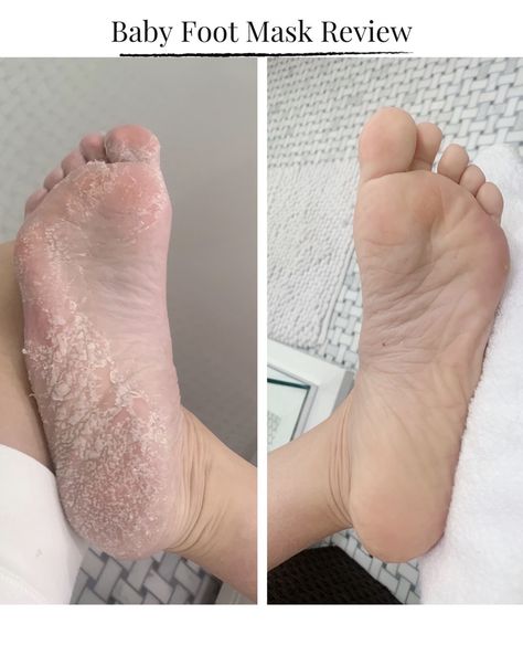 foot peel mask before and after Pedicure Before And After, Aloe Vera For Sunburn, Foot Peel Mask, Home Remedies For Warts, Warts Remedy, Natural Remedies For Migraines, Peeling Mask, Dry Skin Remedies, Skin Natural Remedies