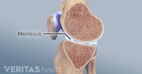 Meniscus Repair Surgery Recovery, Meniscus Surgery Recovery, Knee Meniscus, Meniscus Surgery, Knee Surgery Recovery, Knee Strength, Knee Surgery, Surgery Recovery, Sports Injury