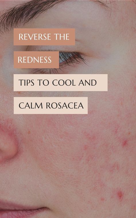 Rosatia Remedies, Redness Remedy, Reduce Face Redness, Redness Reducing Skin Care, Face Redness, Inflammed Skin, Wellness Girlie, Redness On Face, Skin Hacks