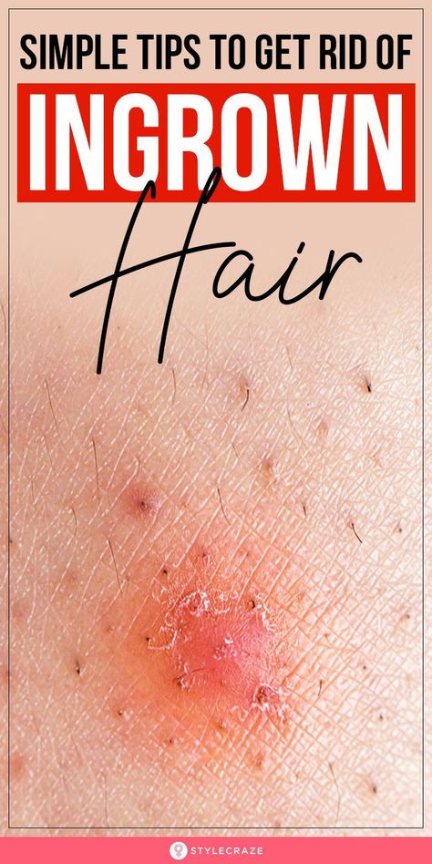 Infected Ingrown Hair, Treat Ingrown Hair, Ingrown Hair Remedies, Bump Hairstyles, Ingrown Hair Removal, Hair Curl, Underarm Hair Removal, Prevent Ingrown Hairs, Ingrown Hairs