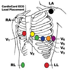 leadplc1.gif (282×288) Ekg Placement 12 Lead, Ekg Lead Placement, 12 Lead Ekg Placement, Ekg Placement, Lead Placement, Ekg Leads, Nursing School Prep, Emt Study, Medical Clinic Design