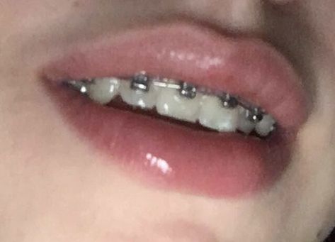 Brackets Aesthetic, Perfect Teeth Braces, Braces Aesthetic, Pink Braces, Braces Food, Cute Braces Colors, Teeth Aesthetic, Getting Braces, Cute Braces