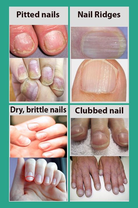 Pitted Nails, Nail Ridges, Nail Fungus Remedy, Tongue Health, Broken Nails, Nail Care Tips, Brittle Nails, Face Wrinkles, Striped Nails