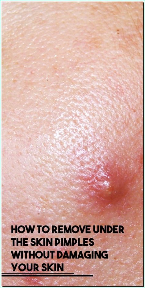 How To Remove Under The Skin Pimples Without Damaging Your Skin Pimple Meaning, Under The Skin Pimples, Blind Pimple, Pimples Under The Skin, Pimples On Face, Skin Natural Remedies, Under The Skin, Acne Cream, Health Awareness