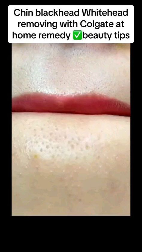 how to get rid of blackheads and Whiteheads ✨💋 Blackheads And Whiteheads, For Blackheads, Rid Of Blackheads, Face Skin Care Routine, Blackheads Removal, Clear Healthy Skin, Diy Skin Care Routine, Good Skin Tips, How To Get Rid Of Pimples