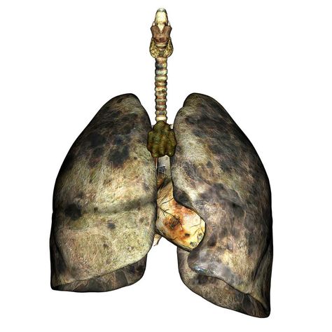 Lung Disease. 3D render of diseased lungs #Sponsored , #AFFILIATE, #SPONSORED, #Disease, #diseased, #render, #Lung Real Lungs, Lungs Illustration, Pollution Activities, Path Illustration, Lungs Anatomy, Anatomy Science, Iron Lung, Ib Art, Mri Scan