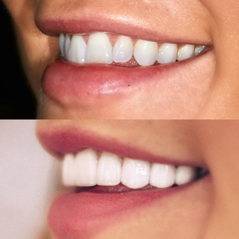 Veneers Before & After: The Prep, The Decision, The Results | Cella Jane Veneers Before And After Small Teeth, Teeth Veneers Before And After, Porcelain Veneers Before And After, Composite Veneers Before And After, Veneers Teeth Styles, Veneers Before And After, Celebrities With Veneers, Teeth Makeover, Natural Veneers