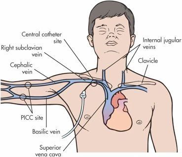 Subclavian Vein, Total Parenteral Nutrition, Parenteral Nutrition, Central Venous Catheter, Nursing Cheat, Interventional Radiology, Nursing School Essential, Nursing Mnemonics, Pharmacy School