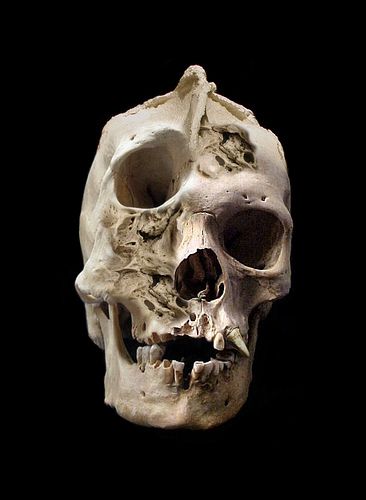 Adult human skull with severe craniofacial deformity. Skull Reference, Human Oddities, Human Skull, Skeletal, Human Anatomy, Skull And Bones, Skull Art, In The Dark, A Black