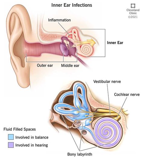 Inner Ear Infection: Symptoms, Signs & Causes Middle Ear Anatomy, Inner Ear Anatomy, Meneires Disease, Ear Drainage, Eustachian Tube Dysfunction, Neurological Assessment, Ear Anatomy, Basic Anatomy, Outer Ear