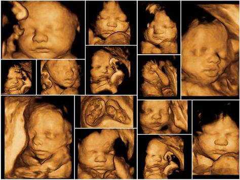 A new article claims that the heartbeats of unborn babies are "imaginary" and that unborn babies aren't really alive. 4d Ultrasound Pictures, Angel Prints, 3d Ultrasound, Care During Pregnancy, Hippocratic Oath, 4d Ultrasound, Ultrasound Pictures, Baby Scan, Fetal Development