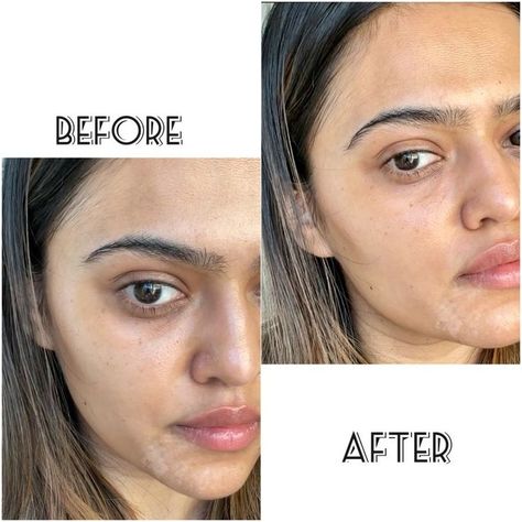 If you are a woman of color, especially if you are Indian, you know how under eye dark circles are kind of a problem for us Indian women. |dark circles| fade dark circles| Vitamin E | Almond oil| skincare routine| skincare regimen| Southasian skin| skincare| under eyes| antiaging| clean skincare| affordable skincare #skincareroutine #darkcircles #skincare #undereyes #antiaging Hyperpigmentation Around Eyes, Hyperpigmentation Indian Skin, Dark Circle Treatments, Indian Skincare Products, Hyperpigmentation Remedies, Color Correct Dark Circles, Dark Circle Remedies, Skin Korean, Affordable Skincare