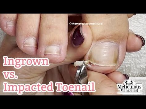 Curled Toenails, Ingrown Toenail Remedies, Fungal Infection Remedies, Infected Toenail, Toenail Health, Toenail Fungal Infection, Toenail Removal, Nail Remedies, Nail Infection