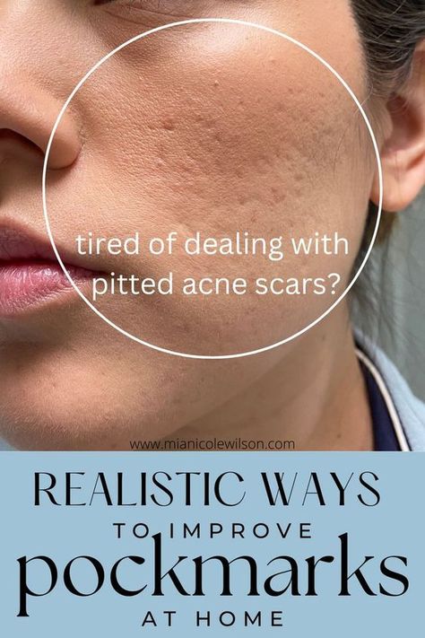 Best Acne Scar Removal, Remove Skin Tags Naturally, Natural Acne Remedies, How To Get Rid Of Pimples, Acne Scar Removal, Acne Solutions, Face Acne, Acne Remedies, Skin Pores