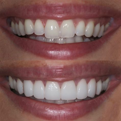 Teeth Makeover, Grow Back Receding Gums, Whiten Teeth Fast, I Healed, Pretty Teeth, Veneers Teeth, Teeth Whitening Diy, Beautiful Teeth, Porcelain Skin