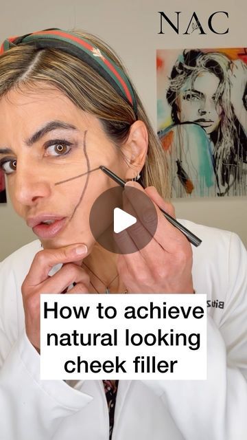 Dr. Bita Zadeh Farrell on Instagram: "Filler placement is an art.   #cheekfiller #drbitafarrell #naturalaestheticscenter" Full Face Fillers Before And After, Mid Cheek Filler, Cheek Filler Injection Sites, Mid Face Filler, Temple Filler Before And After, Cheeks Filler, Cheek Fillers Before And After Face, Facial Balancing Filler, Filler Placement