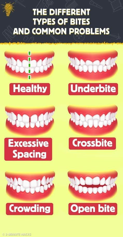 The 5 Different Types of Bites and It’s Problems | Daily Infographic Childhood Development Stages, Extra Teeth, Amalgam Fillings, Types Of Humans, Gum Recession, Human Teeth, Porcelain Veneers, Learn Something New Everyday, Natural Teeth