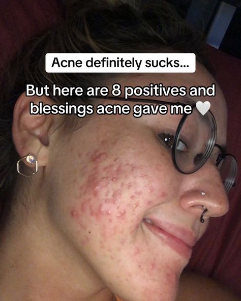 Thank you, acne 🤍. #adultacne #pcosacne #clearskin #glassskin #acnepositivity #acneneutrality Skincare That Helps With Acne, How To Feel Pretty With Acne, What Different Acne Spots Mean, Bad Acne Remedies, Skin Care Routine Acne Prone, Clear Skin Tips Natural, Acne Skin Aesthetic, Pimple Location Meaning, Acne Placement Meaning