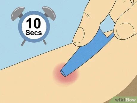 11 Ways to Get Rid of a Mosquito Bite - wikiHow Misquote Itch Relief, Itchy Bug Bite Remedy, Stop Mosquito Bite Itch, Mosquito Bite Relief, Bug Bite Itch, Mosquito Bite Itch, Itchy Bug Bites, Remedies For Mosquito Bites, Bug Bites Remedies