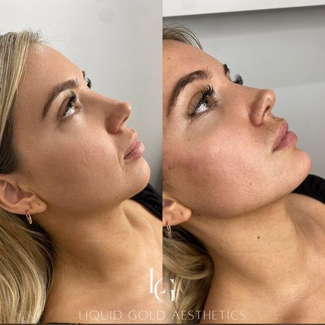 Nose Lift, Face Injections, Gold Aesthetics, Chin Filler, Face Fillers, Lips Inspiration, Face Surgery, Botox Lips, Cheek Contour