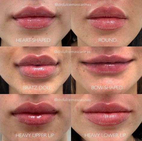 Permanente Make-up, Gaun Koktail, Lips Inspiration, Face Fillers, Facial Fillers, Facial Aesthetics, Lip Filler, Makijaż Smokey Eye, Lip Shapes