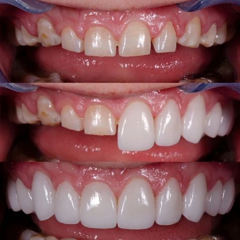 Dental Veneers Before And After, Teeth Implants Before And After, Dental Before And After, Porcelain Veneers Before And After, Dental Implants Before And After, Invisalign Before And After, Veneers Before And After, Veneer Teeth, Teeth Veneers