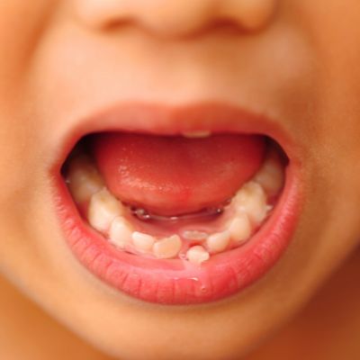 Leg Circuit, Teeth Pictures, Kids Teeth, Loose Tooth, Tooth Removal, Stronger Teeth, Tooth Extraction, Pediatric Dentistry, Baby Teeth