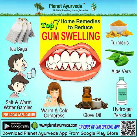 Top 7 #Home #Remedies to #Reduce #gum #swelling #turmeric #aleovera #hydrogenpreoxide #cloveoil #warm&coldcompress #salt #wram #watergargles #teabags #naturalremedies #homeremedies Gum Infection Remedies, Swollen Gums Remedy, Tooth Infection, Wisdom Tooth, Swollen Gum, Used Tea Bags, Coffee With Alcohol, Clove Oil, Turmeric Tea