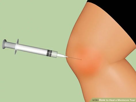 How to Heal a Meniscus Tear (with Pictures) - wikiHow Fitness Improve Leg Circulation, Knee Meniscus, Knee Replacement Exercises, Knee Pain Relief Remedies, Patellofemoral Pain Syndrome, Knee Strength, Knee Pain Remedy, Swollen Knee, Ways To Heal