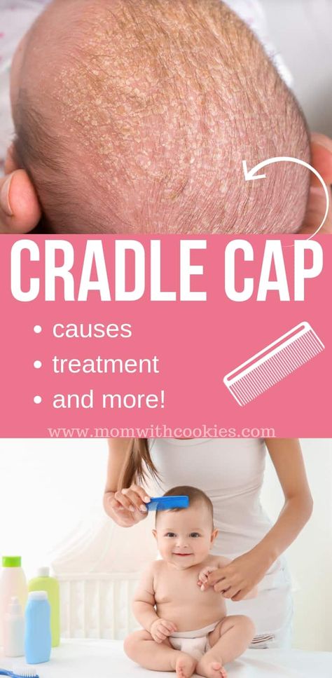 Parents guide to cradle cap...what causes it, how to treat it, and more. Baby Dandruff, Cradle Cap Remedies, Baby Cradle Cap, Puree Recipes, Fruit Baby, Cradle Cap, Baby Puree, Newborn Hacks, Baby Cradle