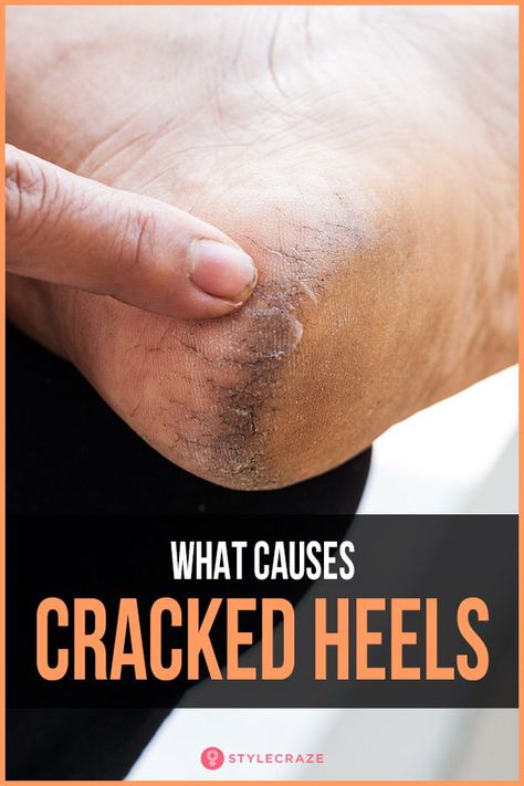 What Causes Cracked Heels? #trending #trends #trendingnow Soften Heels Diy, Soft Heels Remedies, Soft Heels How To Get, Rough Feet Remedy Heels, Healing Cracked Heels, How To Get Rid Of Cracked Heels, How To Heal Cracked Heels, Dry Heels How To Get Rid Of, Heel Cracks Remedies