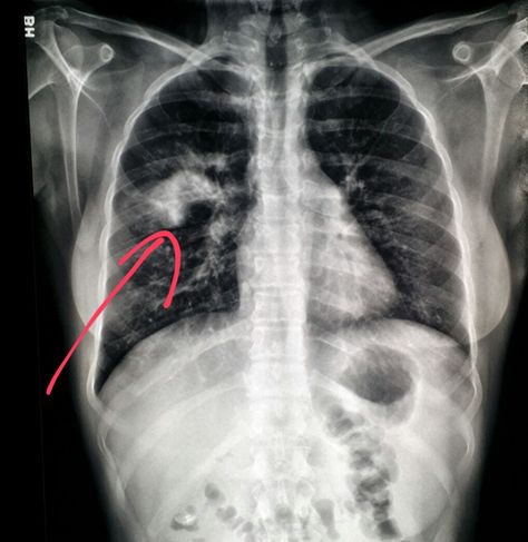 #Chest #xray shows #pneumonia in a young #woman with a #cough.  #radiology #radiologist #pain Chest Xray, Radiology, X Ray, Young Woman, Abstract Artwork, Quick Saves