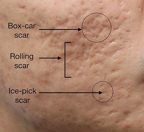 Skincare Knowledge, Acne Scaring, Derma Rolling, Skin Peel, Natural Oils For Skin, Greasy Skin, Acne Vulgaris, Natural Acne Remedies, Acne Scar