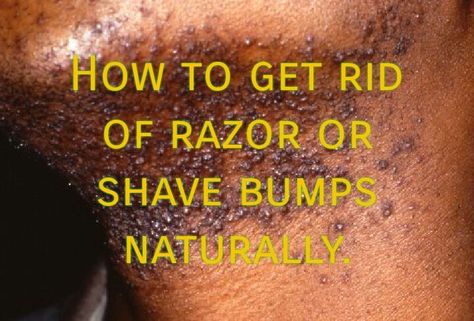 Remove Razor Bumps, Razor Burn Remedies, Razor Bumps Remedy, Waxing Vs Shaving, Natural Hair Removal Remedies, Shave Hair, Shaving Bumps, Bump Hairstyles, Chin Hair