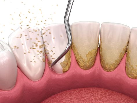 In this 3-part series, we examine the history and evolution of nonsurgical periodontal therapy by taking a deep dive into scaling and root planing. Scaling Teeth, Tooth Art, Dental Mouthguards, Dental Quotes, Dental Office Architecture, Dental Hygiene Student, Dental Images, Dental Posters, Dentist Clinic