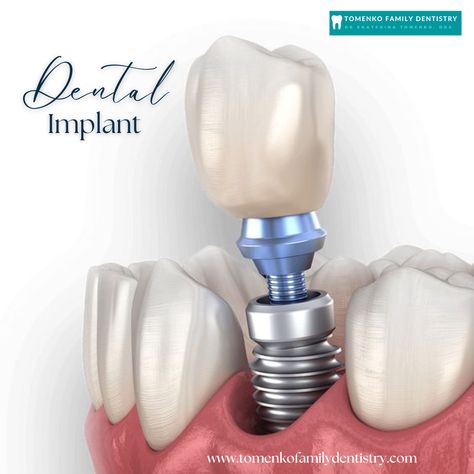 Our office is here to help you! We offer high quality dental implant procedure to help restore your smile. 
Contact us today to learn how dental implants can benefit you.
📲 301-439-8333 Dentist Ideas, Dental Post, Dental Advertising, Cosmetic Dentistry Procedures, Dental Photos, Dental Implant Procedure, Dental Posts, Teeth Dentist, Medical Animation