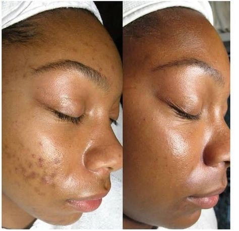 Resultados skincare 
Benefícios skincare 
Aesthetic skin
Better skin 
Spring 🌼
Cuidados com a pele
SKINCEPTION Acne Holes, Hyperpigmentation Mask, Aloe Face Mask, Before And After Skincare, Vision Board For 2023, Esthetician Marketing, Health Poster, Skin Hyperpigmentation, Prevent Ingrown Hairs