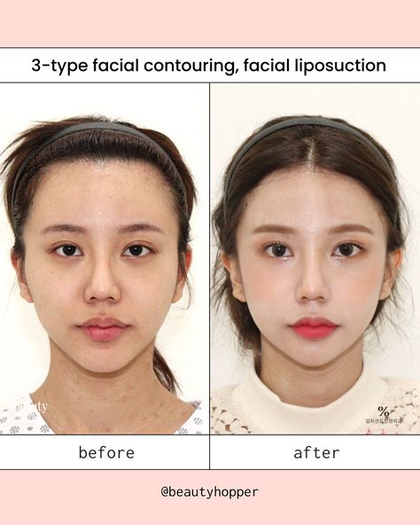 Facial contouring surgery can help create a more balanced and attractive look by reshaping the bones in your face 🧚‍♀️  Common procedures include cheekbone reduction, jaw reduction, & chin reshaping. These will be customised to your specific needs and combined for the best results👍🏻 Although the recovery period to see full results can be lengthy, many patients find the permanent results well worth it✨ Let us help you plan a safe and successful plastic surgery trip to Korea  ❤️ For all inqu... Face Contouring Surgery, Facial Contouring Surgery, Cheekbone Reduction, Kpop Plastic Surgery, Change Appearance, Trip To Korea, Face Transformation, Face Surgery, Plastic Fantastic