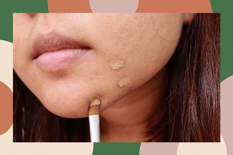 How To Conceal Pimples, White Bumps On Face, How To Cover Pimples, Red Spots On Face, Neck Pimples, Cover Pimples, Cover Up Pimples, Huge Pimple, Inflamed Pimple