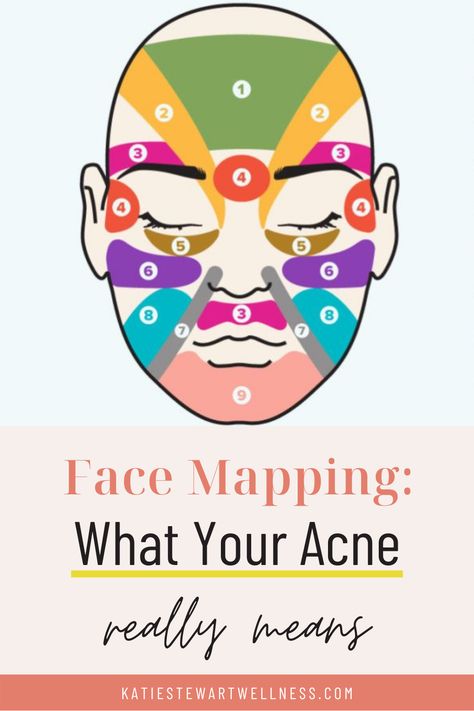 Acne On Face Meaning, Pimple Chart, Acne Chart, Acne Face Mapping, Cheek Acne, Face Map, Chin Acne, Acne Tips, Face Mapping Acne