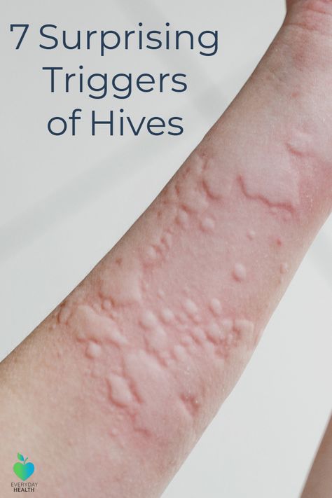 Did you know a #workout can trigger #hives? Hives Remedies, Chronic Hives, Home Remedy For Cough, Everyday Health, Natural Cough Remedies, Cough Remedies, Daily Health Tips, Oral Health Care, Tooth Decay